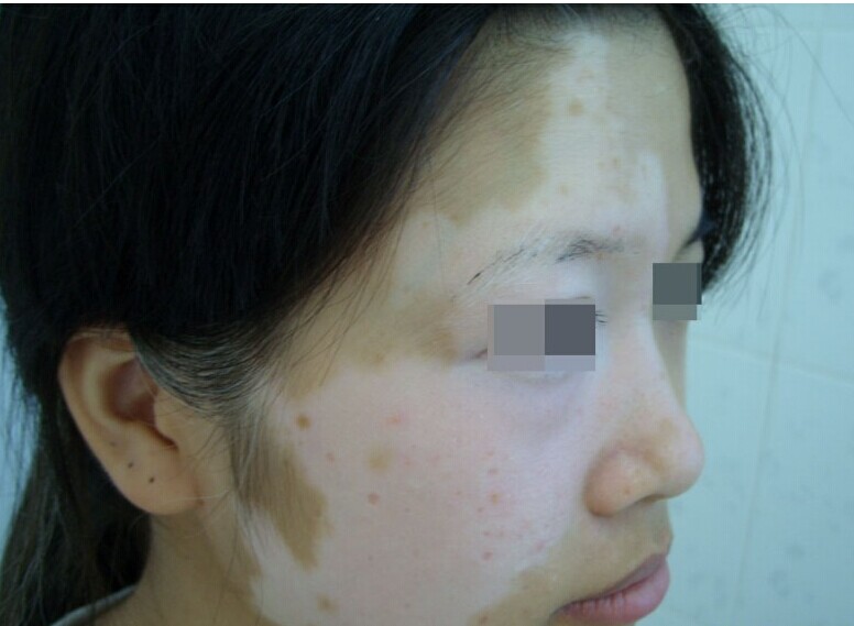 白癜风患者怀孕没问题吗.jpg