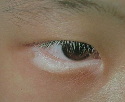 儿童白癜风的治疗.jpg