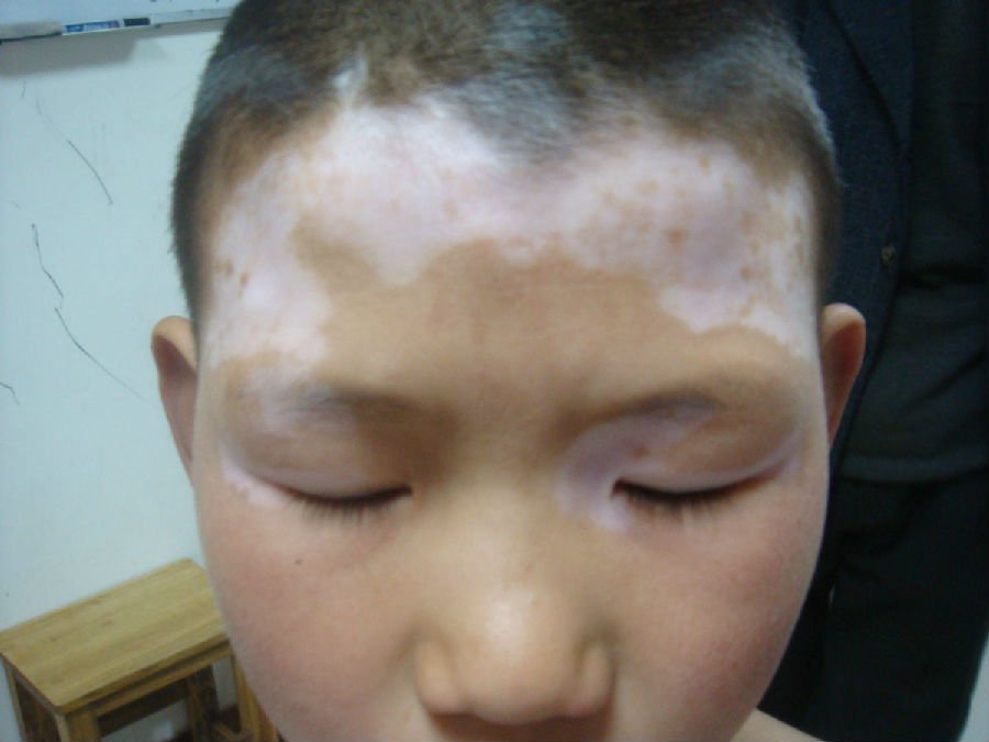 青少年患白癜风的危害.jpg