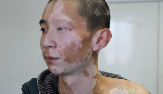 青少年白癜风禁忌.jpg