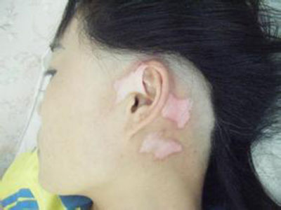 如何预防儿童白癜风.jpg