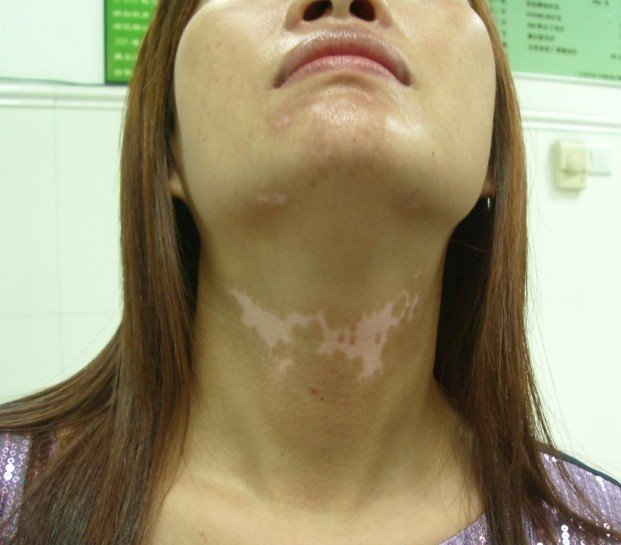 女性白癜风.jpg
