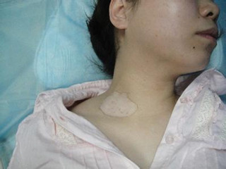 关于女性白癜风.jpg