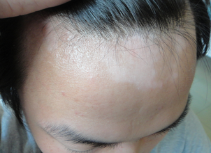 女性头部白癜风患者如何护理.jpg
